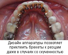 брекеты Инкогнито брекеты Инкогнито