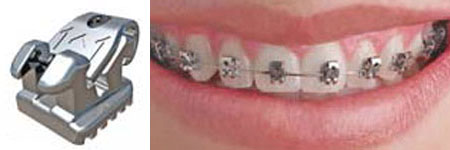  T3 American Orthodontics