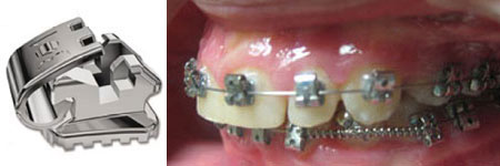 брекеты Time 2 American Orthodontics