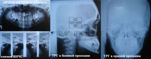 консультация ортодонта консультация ортодонта