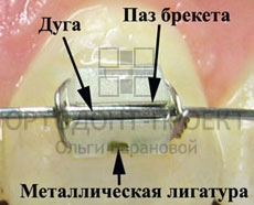 лигатурные брекеты лигатурные брекеты