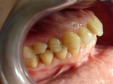 дистальный прикус - до лечения у ортодонта