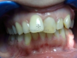 дистальная окклюзия - до ортодонтического лечения