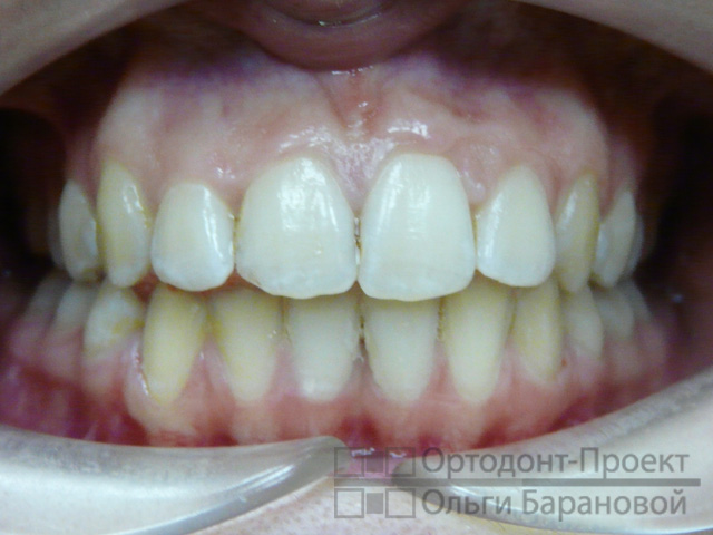 вид зубов после ортодонтического лечения