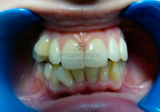 выравнивание зубов у взрослых - до лечения