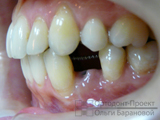 результат ортодонтической подготовки к протезированию зубов