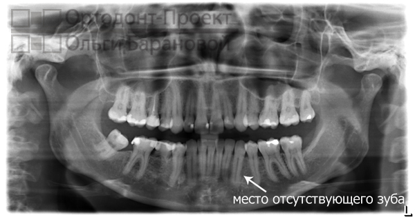 панорамный снимок зубов до лечения у ортодонта