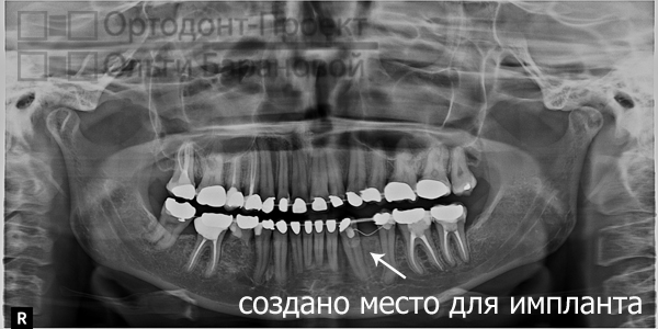 панорамный снимок зубов после ортодонтической подготовки к протезированию