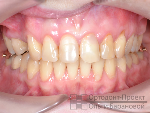 вид зубов после ортодонтического лечения