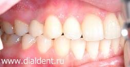 протезирование зубов на имплантах в "Диал-Дент"