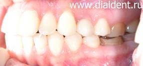 протезирование зубов на имплантах в "Диал-Дент"