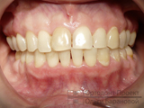 результат ортодонтической альтернативы протезированию зубов