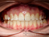 результат ортодонтического лечения и протезирования зубов