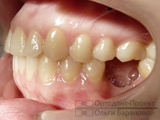 результат ортодонтической подготовки к протезированию зубов
