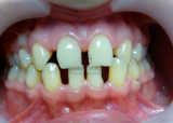 ортодонтическая подготовка к протезированию