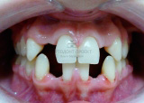 ортодонтическая подготовка к протезированию окончена