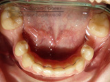 зубы подготовлены к протезированию на имплантах