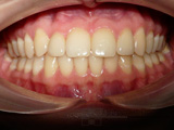 результат ортодонтического лечения и протезирования зубов