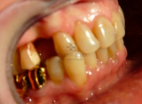 подготовка перед протезированием зубов 