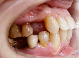 подготовка перед протезированием зубов - результат