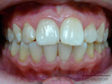 до лечения у ортодонта - выступающие передние зубы