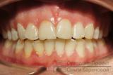 до лечения у ортодонта - скученность зубов