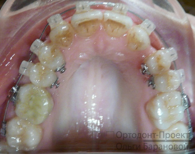 Брекеты отсутствие зубов лечение