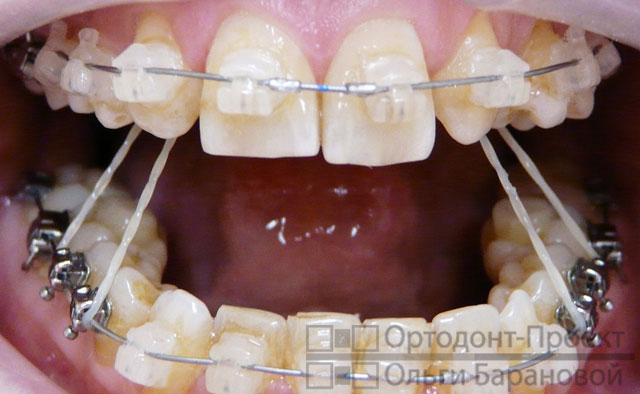 Брекеты отсутствие зубов лечение