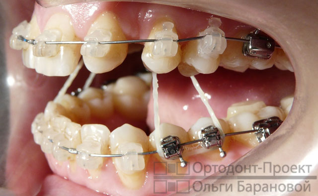 Брекеты отсутствие зубов лечение