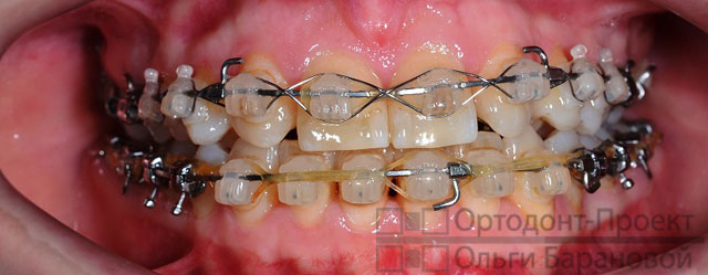 Брекеты отсутствие зубов лечение