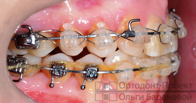 Брекеты отсутствие зубов лечение