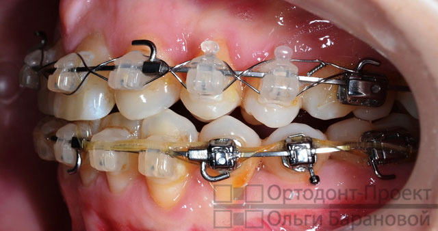 Брекеты отсутствие зубов лечение