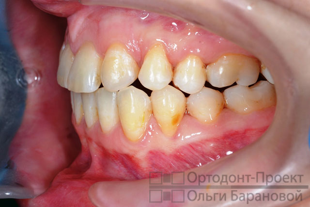 Брекеты отсутствие зубов лечение