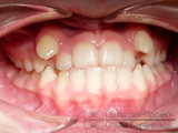 до лечения у ортодонта - зубам не хватает места в ряду