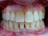 после лечения у ортодонта при скученности зубов