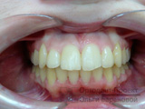 после лечения у ортодонта при скученности зубов