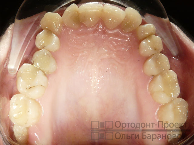 Когда удаляют зуб при ортодонтическом лечении