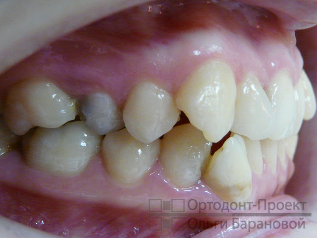Какие зубы лучше удалять при ортодонтическом лечении