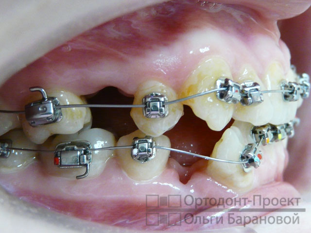 Ортодонтическое лечение с удалением зубов до и после thumbnail