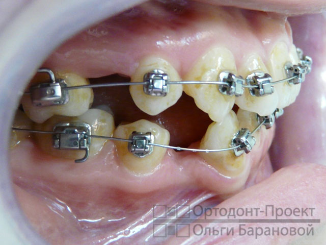 Ортодонтическое лечение когда удаляют зубы thumbnail