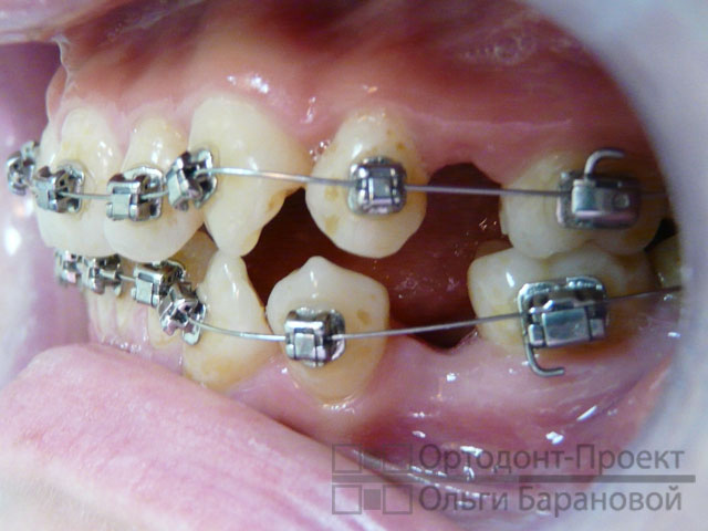 Какие зубы лучше удалять при ортодонтическом лечении
