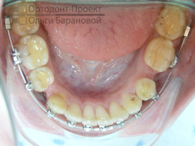 Ортодонтическое лечение с удалением зубов до и после