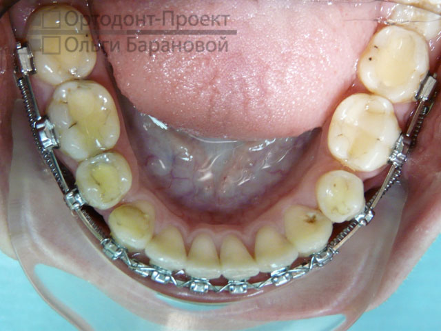 Лечение прикуса с помощью удаления зубов