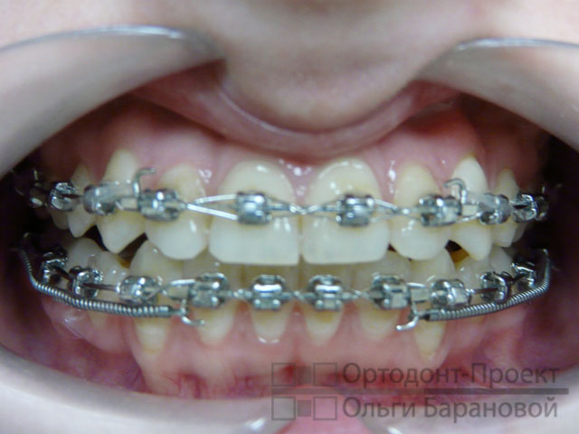 Лечение прикуса с помощью удаления зубов