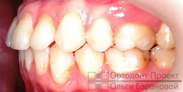 Ортодонтическое лечение с удалением зубов до и после