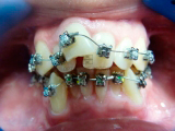 ортодонтическое лечение на брекетах
